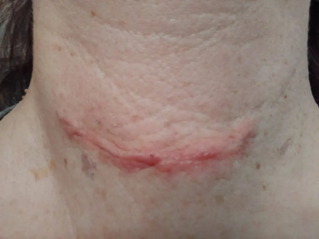 How To Fade A Surgery Scar