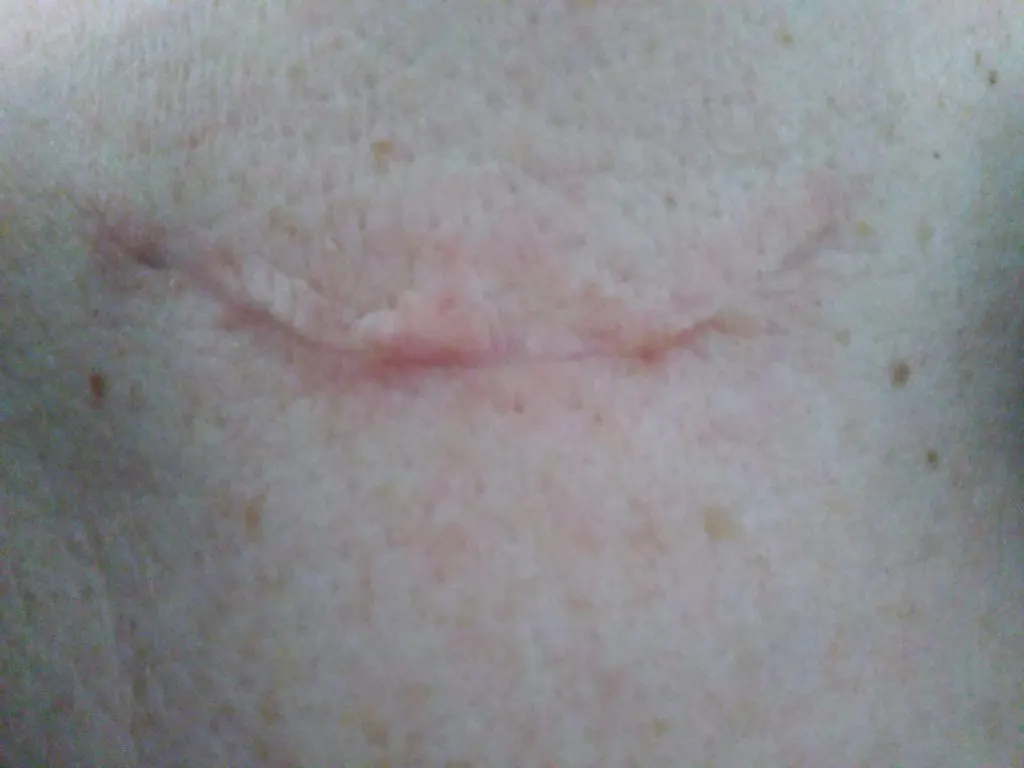 How To Fade a Surgery Scar