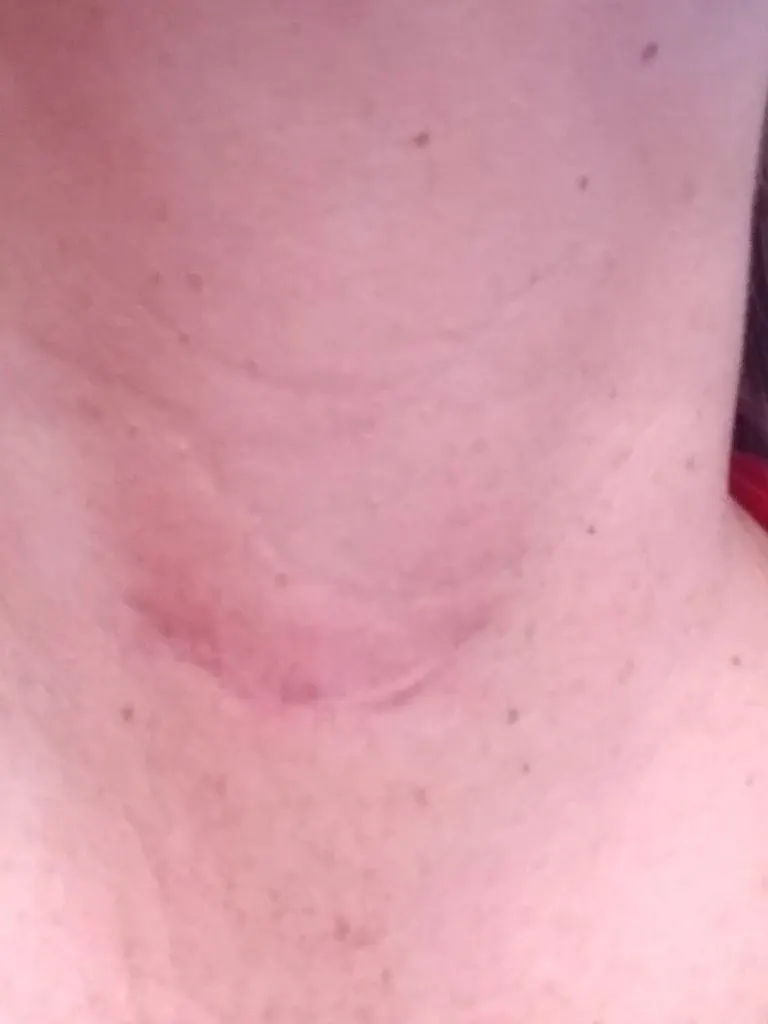 How To Fade a Surgery Scar